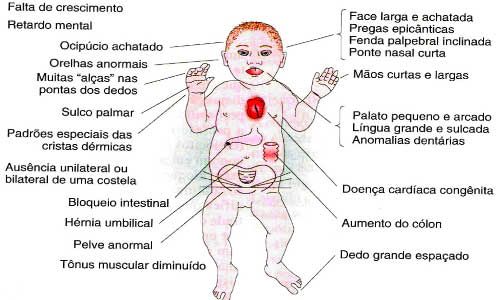 esquema de sindrome de down